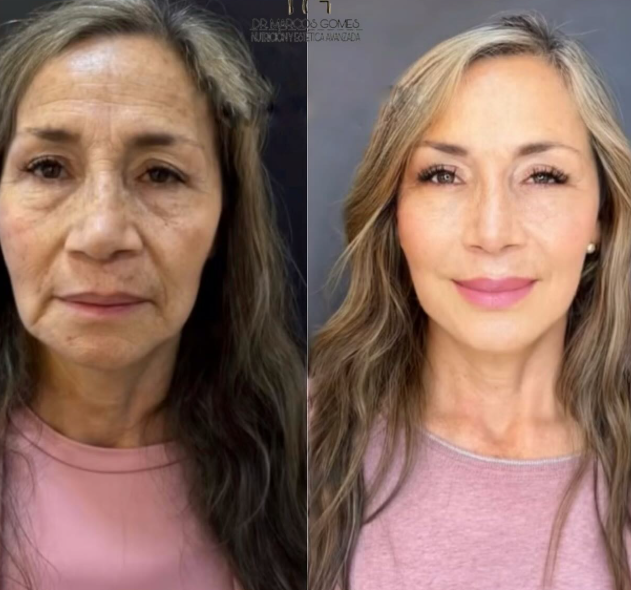 Four-month facial harmonization result using: two CO2 laser sessions,  injectables
